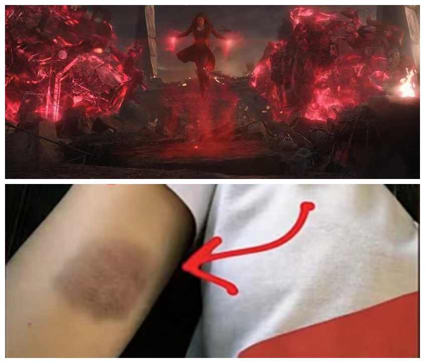 盘点漫威演员拍戏时的受伤片段,蜘蛛侠鼻青脸肿,钢铁侠耍帅受伤-共青