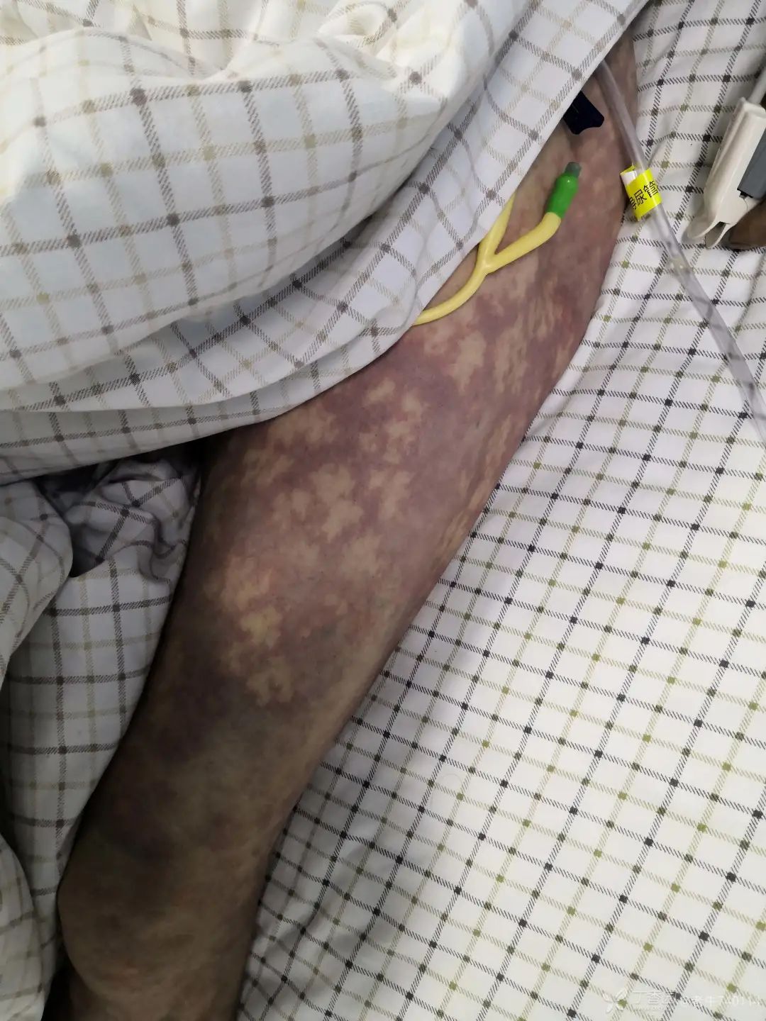 突发腰腹疼痛,周身紫色花斑,入院半小时后抢救无效死亡