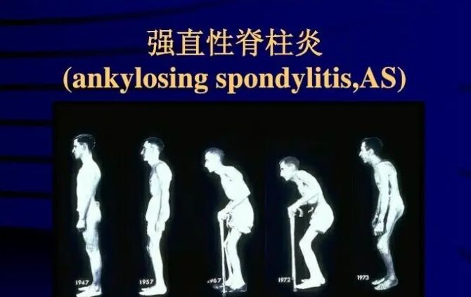 强直八个不,缓解发展不痛苦|强直性脊柱炎|患者|脊柱_新浪新闻