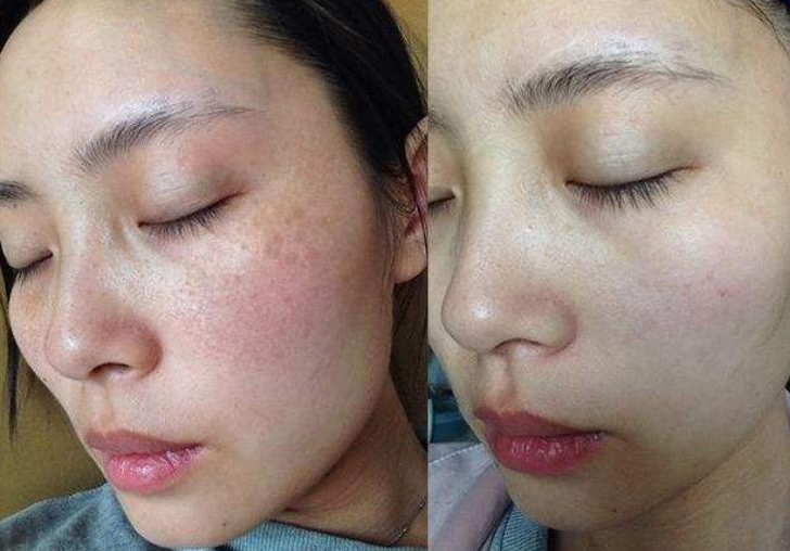 皮肤经常敏感怎么办教你3招全面改善敏感肌