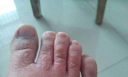 关于汗疱疹可以涂身体乳吗的信息 关于汗疱疹可以涂身体乳吗的信息