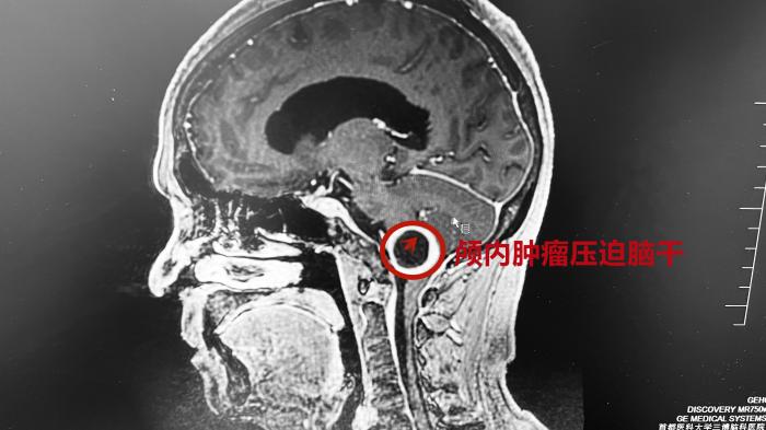 头痛十余年,确诊时脑部的肿瘤已长出"尾巴",上压脑干下延颈部__财经