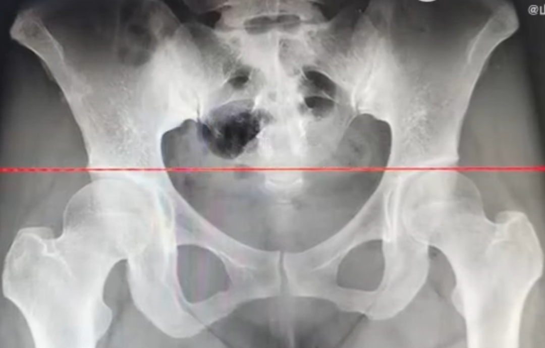 女生长期跷二郎腿，导致两腿长短不一休闲区蓝鸢梦想 - Www.slyday.coM