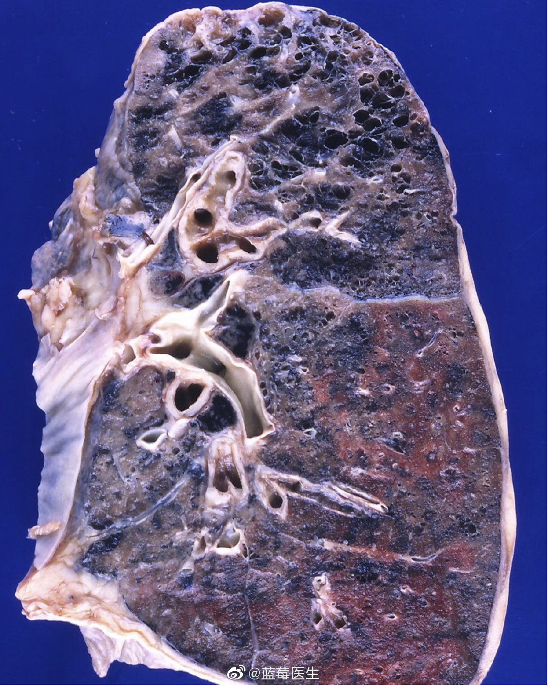 一个上肺叶肺气肿的肺抽烟的小伙伴们好好看看