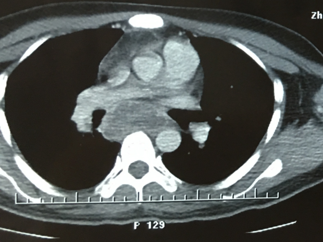 图2—32 急性血行播散性肺结核-胸部X线影像学图鉴-医学