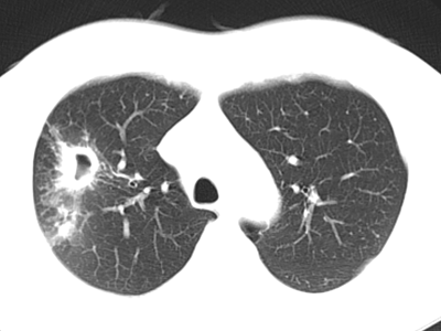 肺结核如何诊断从胸部ct到实验室检查一文讲清世界防治结核病日