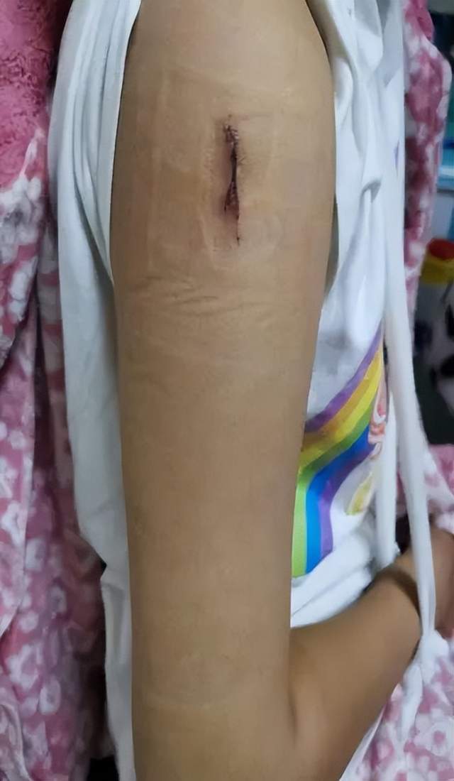 二一五医院骨科医院弹性髓内钉技术之小儿肱骨篇
