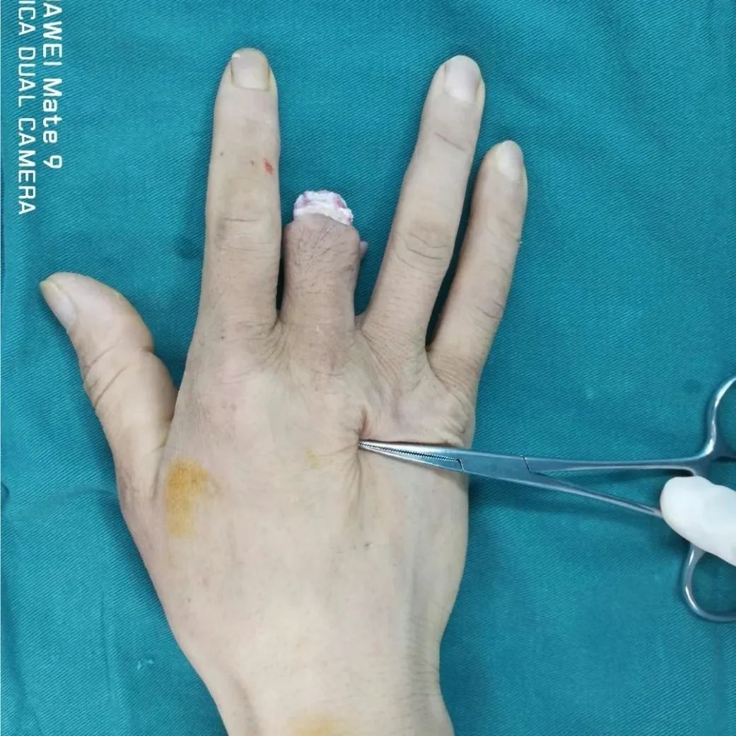 脚趾变手指咸阳市中心医院手足外科神奇的移花接木