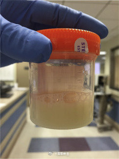 学霸们病例讨论什么情况下会出现乳糜尿