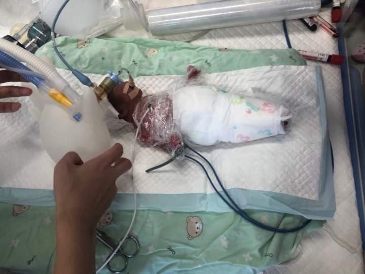 一斤多重的超早产儿刚出生就插满管子进了保温箱出院时爸妈都哭了