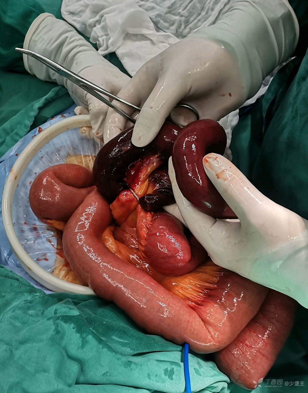 老年女性无腹部手术史却因腹腔金属环致肠坏死切除原因竟是