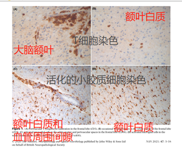 图2 解剖后脑病理切片