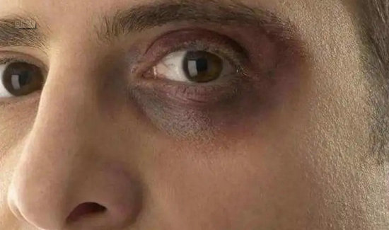 有熊猫眼不一定是熬夜的锅