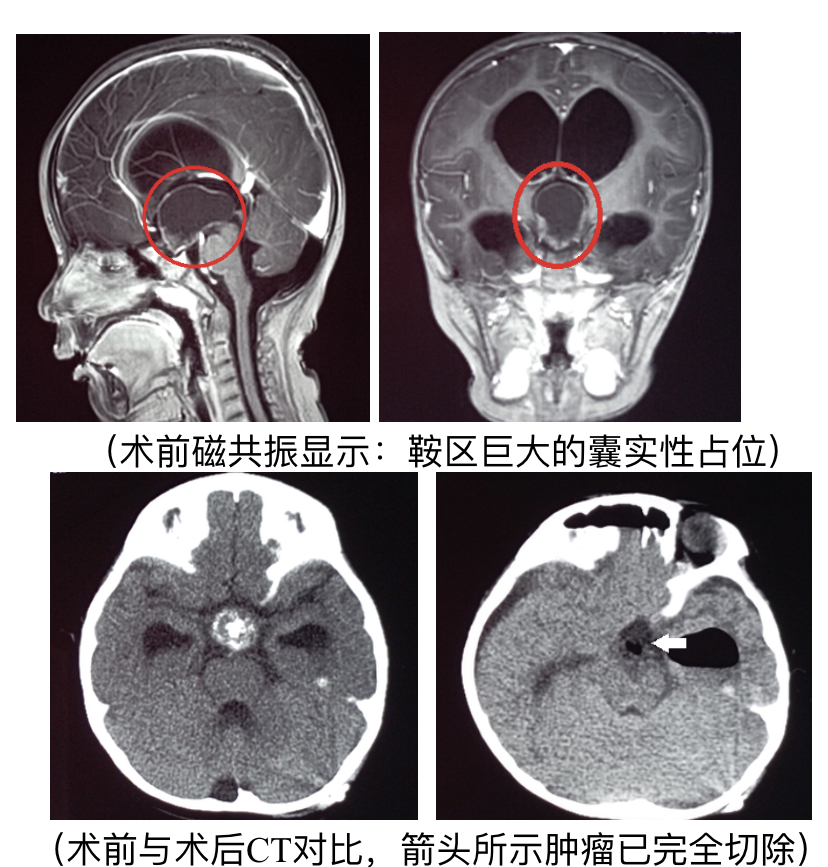 3岁孩子走路像醉酒这种良性肿瘤被称为生物学恶性