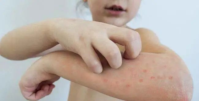 深圳肤康皮肤病专科春季皮炎又来袭查清过敏原是关键