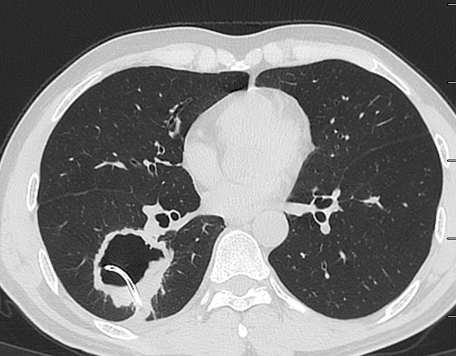 看到胸膜下肺脓肿就放引流管大错特错