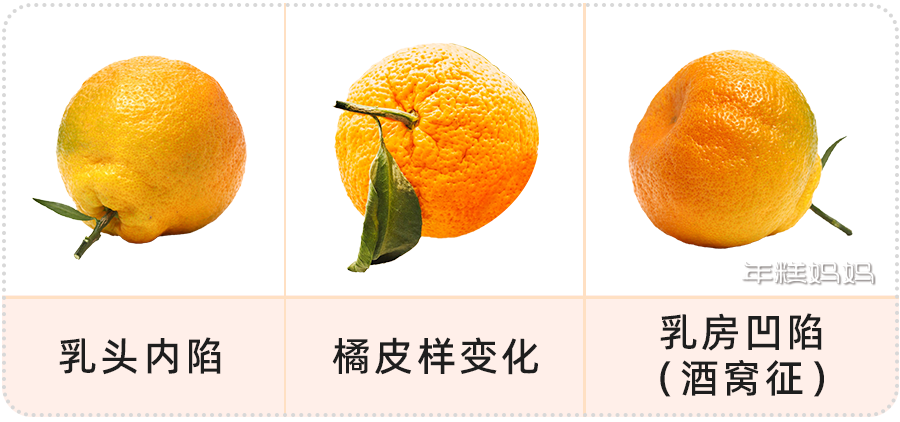 38岁女子因这个小毛病发现乳腺癌医生小症状也要当心早点发现能救命