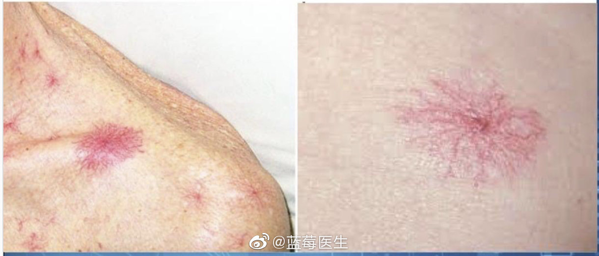 肝硬化时的蜘蛛痣,像星星一样闪烁在身体的不同地方