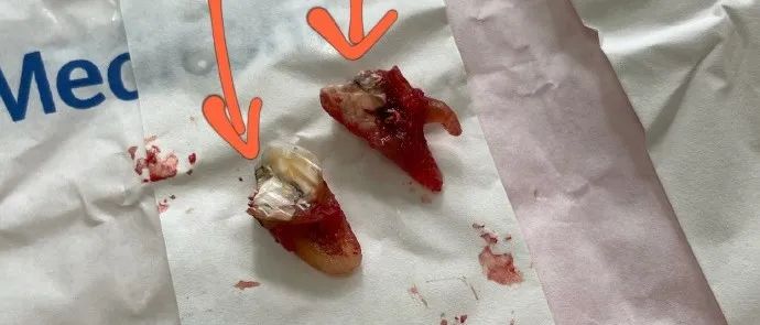 汉堡王薯条吃出"石子"崩碎牙,38岁女子中断备孕急哭!