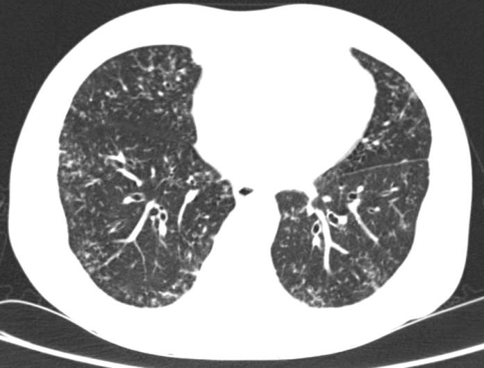 铜绿假单胞菌感染抗菌药选用有讲究