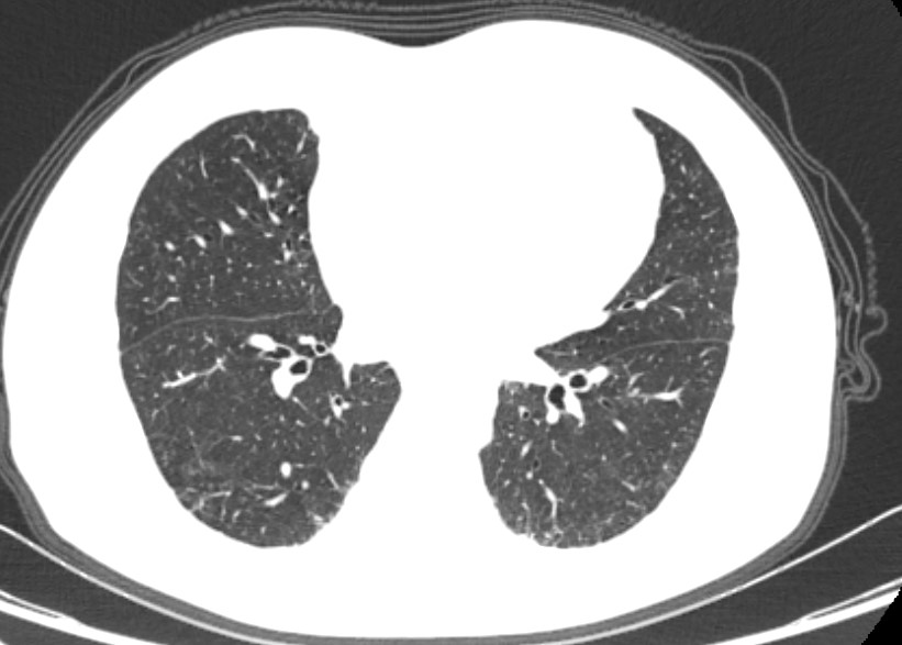 铜绿假单胞菌感染抗菌药选用有讲究