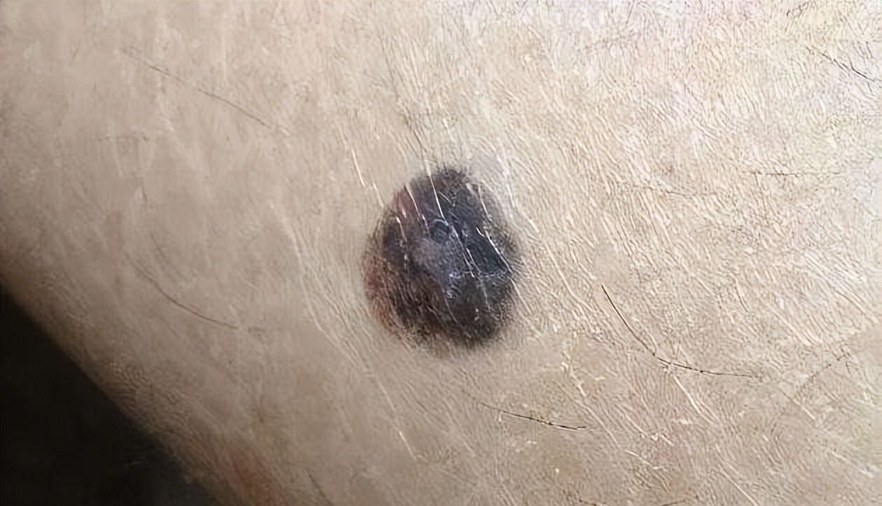 普通痣与黑色素瘤的区别在哪里身上的痣别乱点