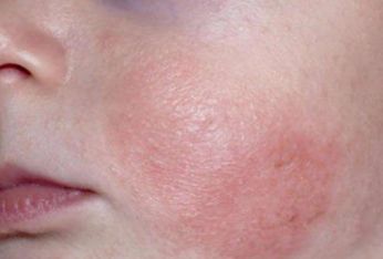 宝宝长痤疮会留疤吗痤疮与痱子湿疹有啥不同呢