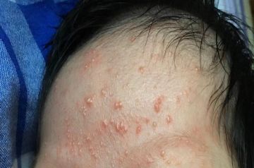 宝宝长痤疮会留疤吗痤疮与痱子湿疹有啥不同呢