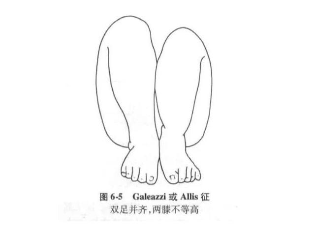 宝宝长短腿家长警惕这个病