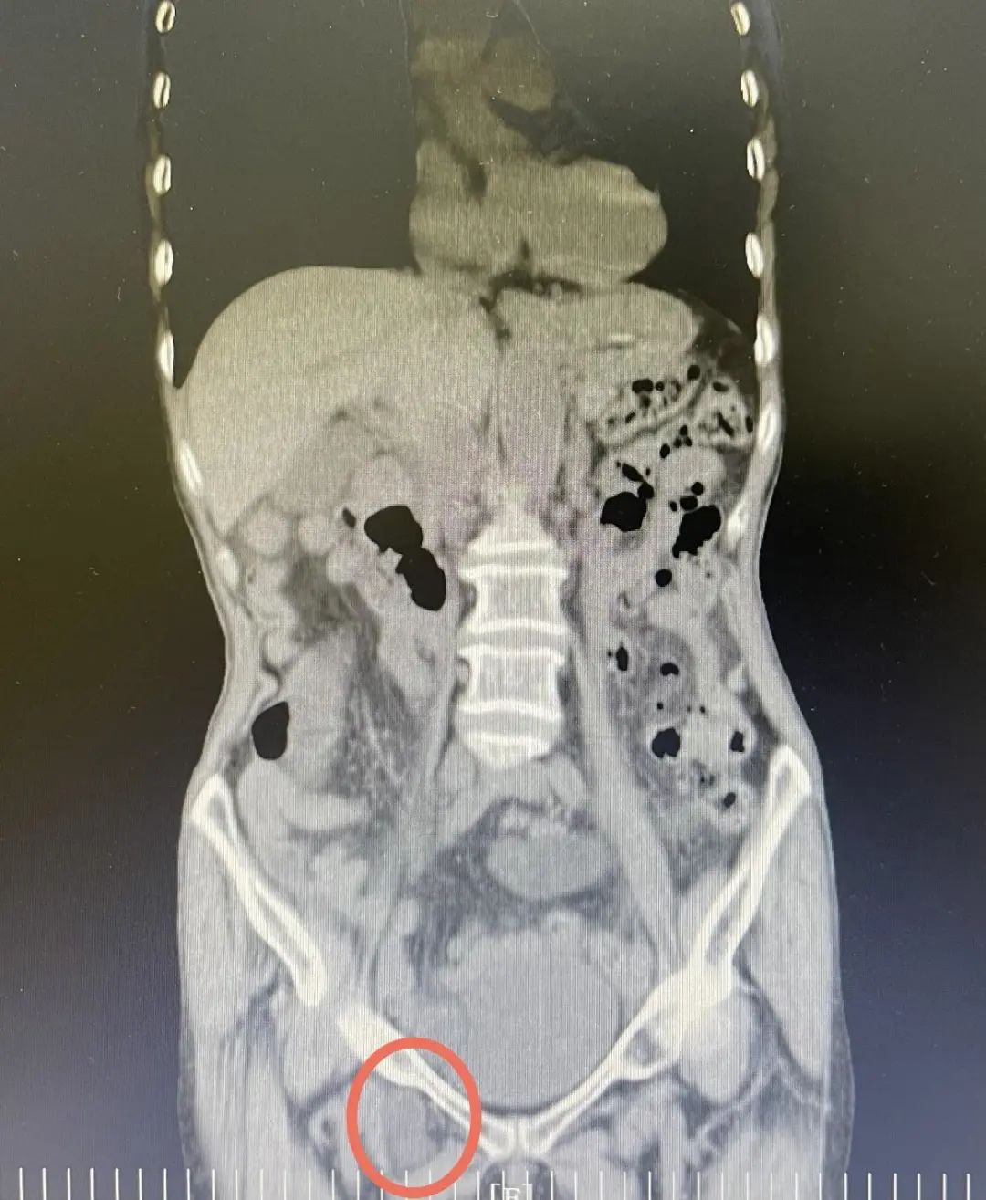 主管的于洁副主任医师详细询问病史,仔细查体后发现患者右侧腹股沟