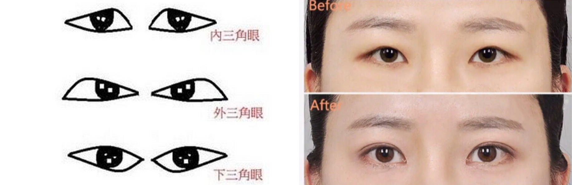 判断你的单眼皮“好看”还是“不好看”，有3个标准，很容易区分