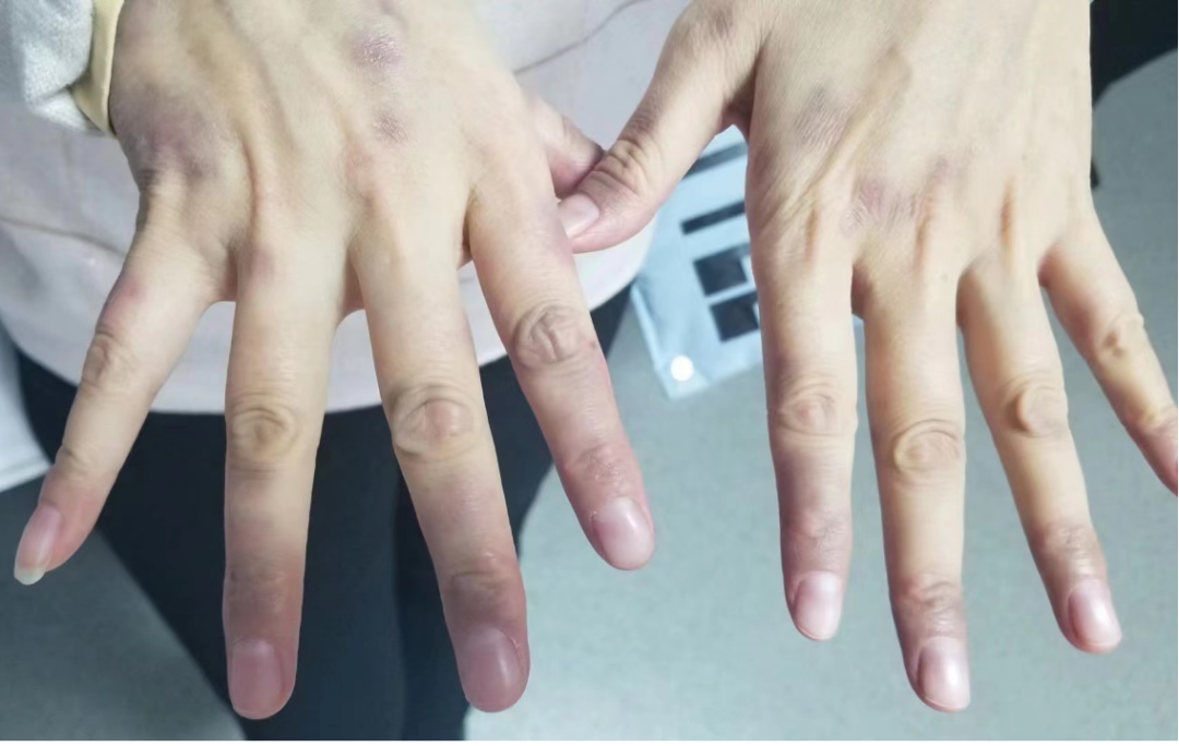 肿瘤专家手指出现这个变化千万要小心这可能是肺癌的前期信号