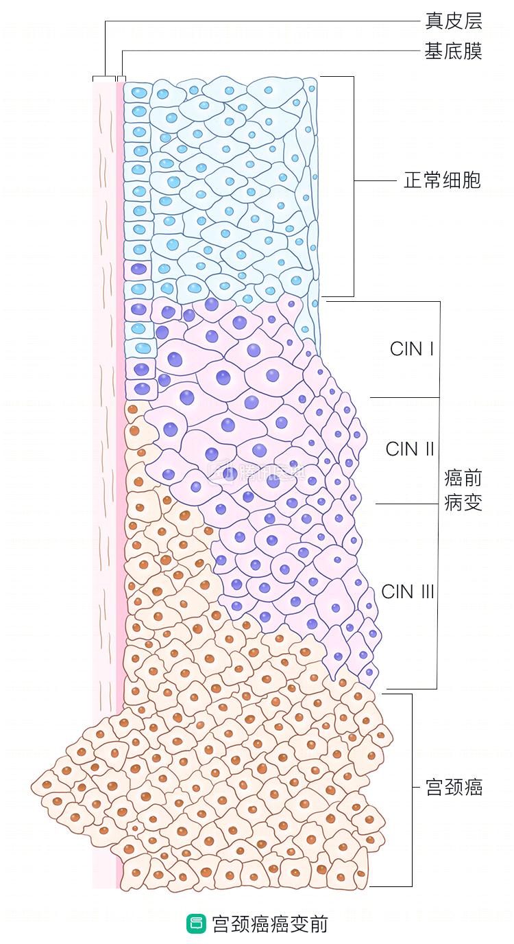感染hpv后怎么做才能转阴