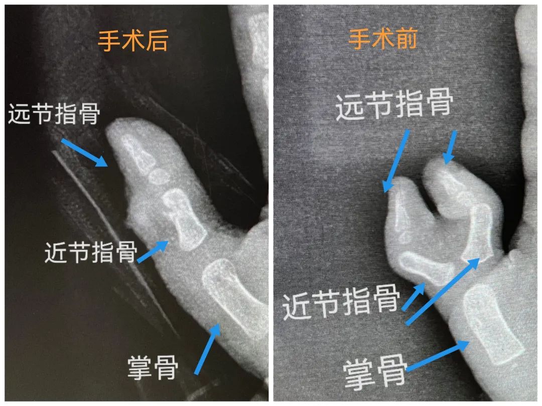 幼童一出生长了六指蟹钳手医生巧思拼好了