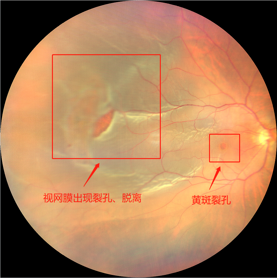 一个裂孔变成两个裂孔,再一步牵拉导致视网膜脱离(简称"网脱")