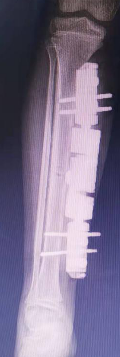 9岁女童遭遇车祸致严重创伤, 中心医院MDT全力救治成功休闲区蓝鸢梦想 - Www.slyday.coM