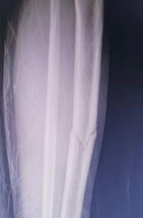 9岁女童遭遇车祸致严重创伤, 中心医院MDT全力救治成功休闲区蓝鸢梦想 - Www.slyday.coM