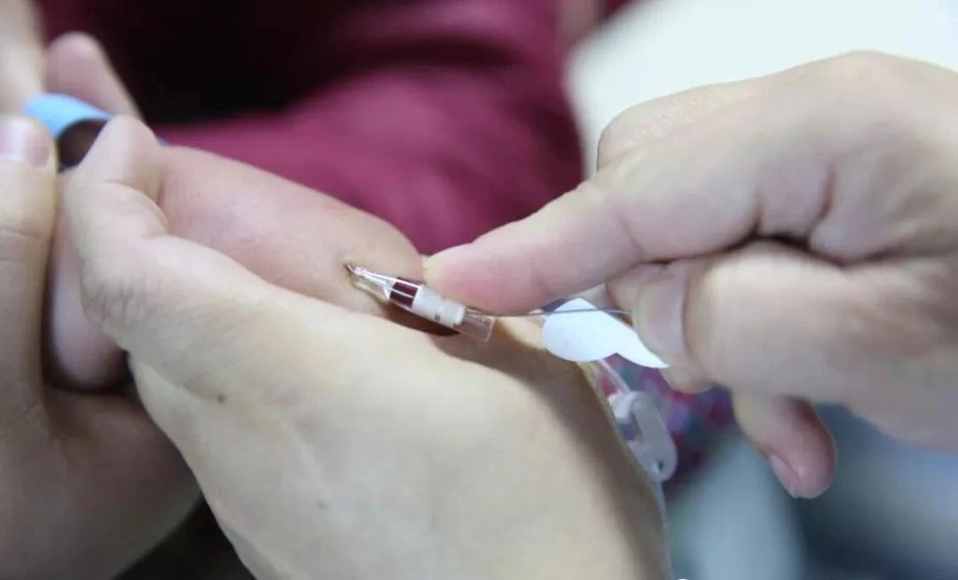 软管全部送入血管内,这时我们继续上述方法单手退针至最大限度,此时