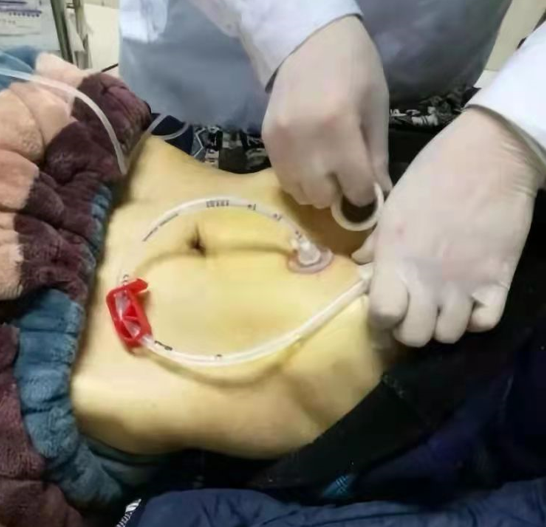 经皮内镜胃造瘘术——让吃饭不再难__财经头条