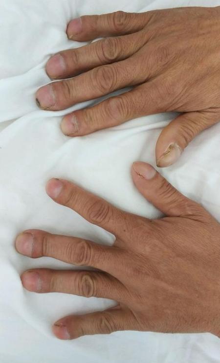 身体出现4种表现,可能是肺部已经受损,最好检查一下|肺部|受损|印堂_