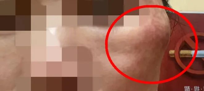 太可怕！女子在福州打美容针后“毁容”！脸上触目惊心……休闲区蓝鸢梦想 - Www.slyday.coM