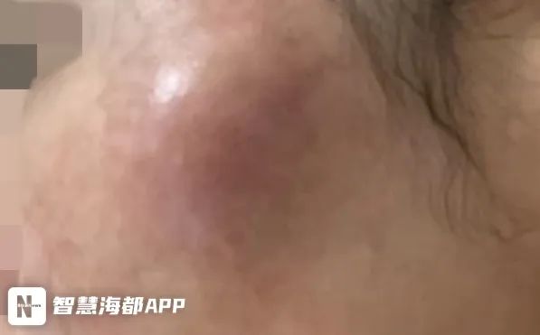 太可怕！女子在福州打美容针后“毁容”！脸上触目惊心……休闲区蓝鸢梦想 - Www.slyday.coM
