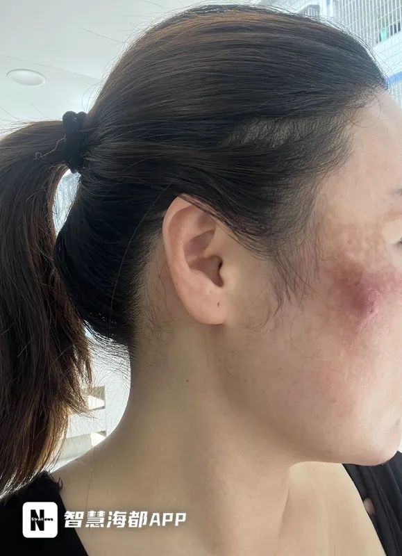 太可怕！女子在福州打美容针后“毁容”！脸上触目惊心……休闲区蓝鸢梦想 - Www.slyday.coM