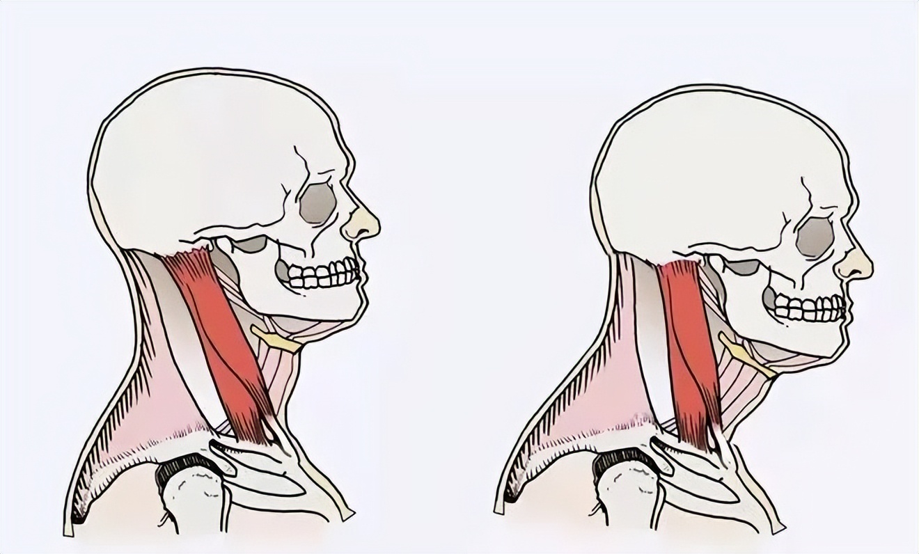 颈椎病|肌肉|姐妹_新浪新闻