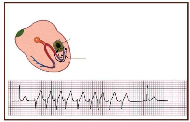 谭红伟大夫:早搏是什么,需要治疗吗?|心电图_新浪新闻