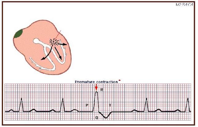 谭红伟大夫早搏是什么需要治疗吗