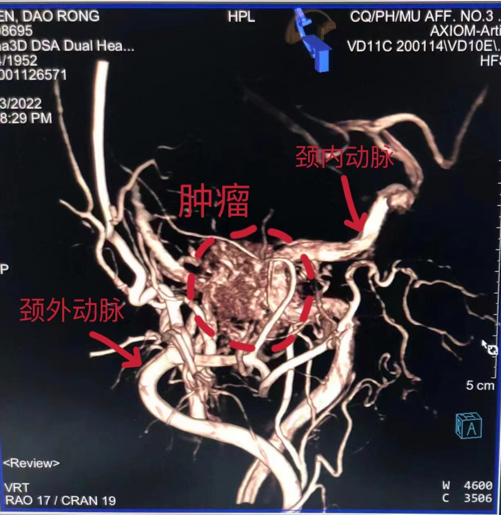 经科室大讨论后,初步确定为c2型的颈静脉球瘤,最好的治疗方式,就是