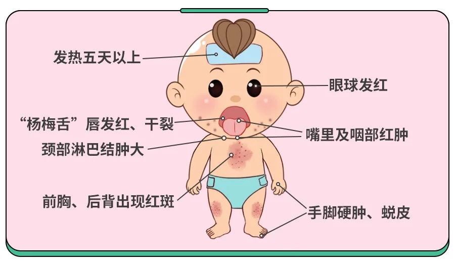 川崎病被误诊我差点失去2岁儿子娃有这6个特征千万去大医院