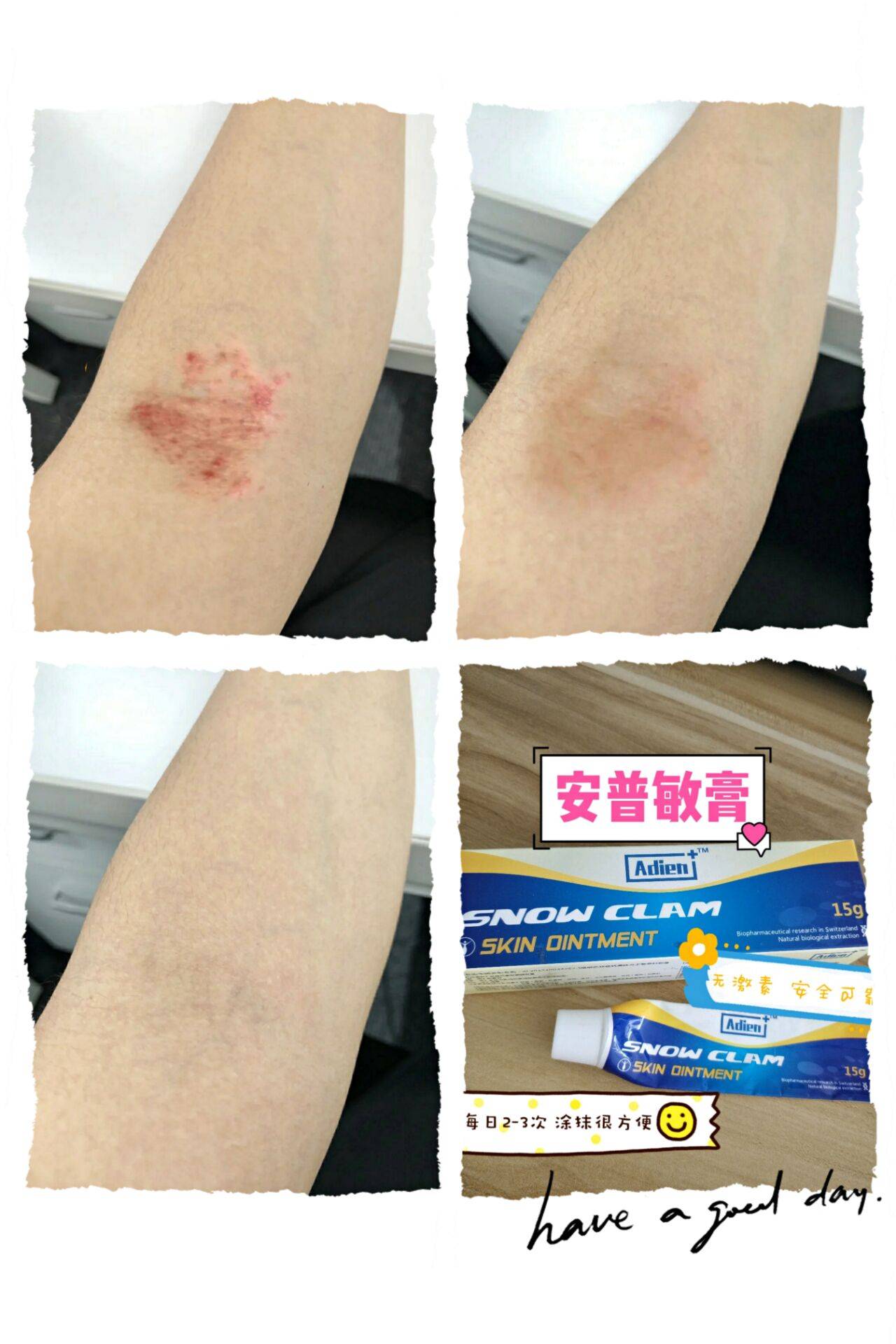 湿疹是什么原因引起的