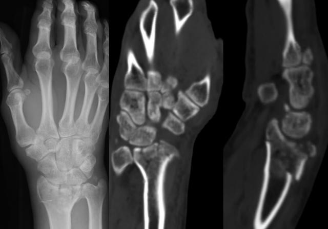 医生精准接骨复位 外卖小哥右手保住了 桡骨 右手 复位 新浪新闻 医生精准接骨复位 外卖小哥右手保住了 桡骨 右手 复位 新浪新闻